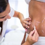 Clinician marking a woman's lower back with chalk lines for surgical planning or treatment prep to guide incisions or contouring.