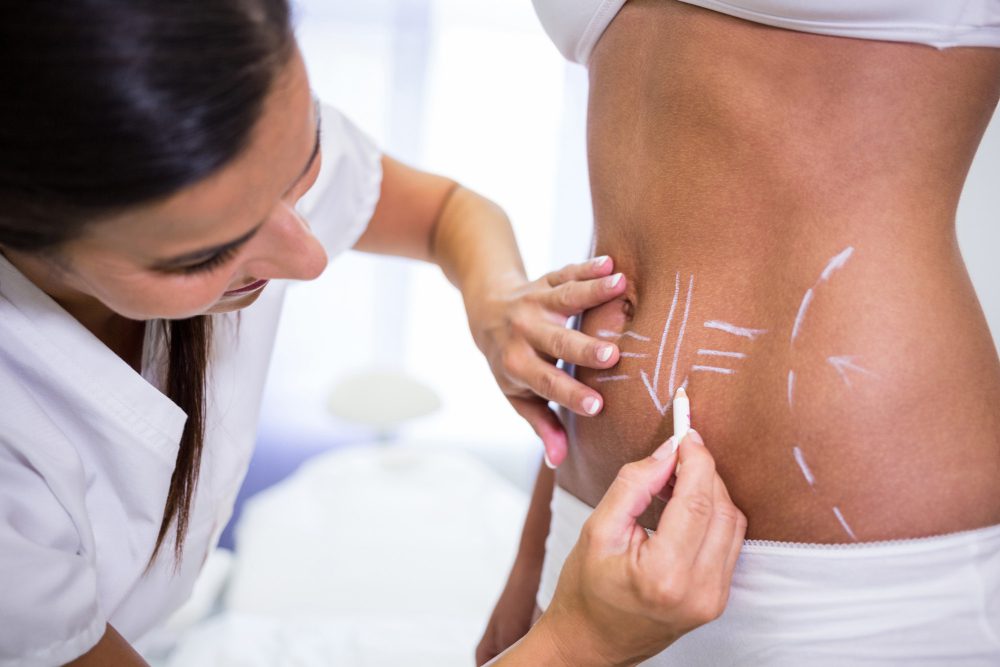 776269 - Etérea Fisioestética - Revista DeBelleza.Es Clinician marking a woman's lower back with chalk lines for surgical planning or treatment prep to guide incisions or contouring.