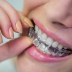 Close-up of a person inserting a clear dental aligner over their upper teeth with their fingers.