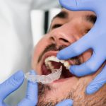Gloved hands fitting a clear dental aligner onto a patient's upper teeth during a checkup or orthodontic fitting.