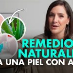 cómo encontrar oportunidades en Cómo deshacerse del acné con tratamientos naturales